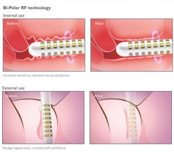 Silk'n - Tightra Vaginal Rejuvenation